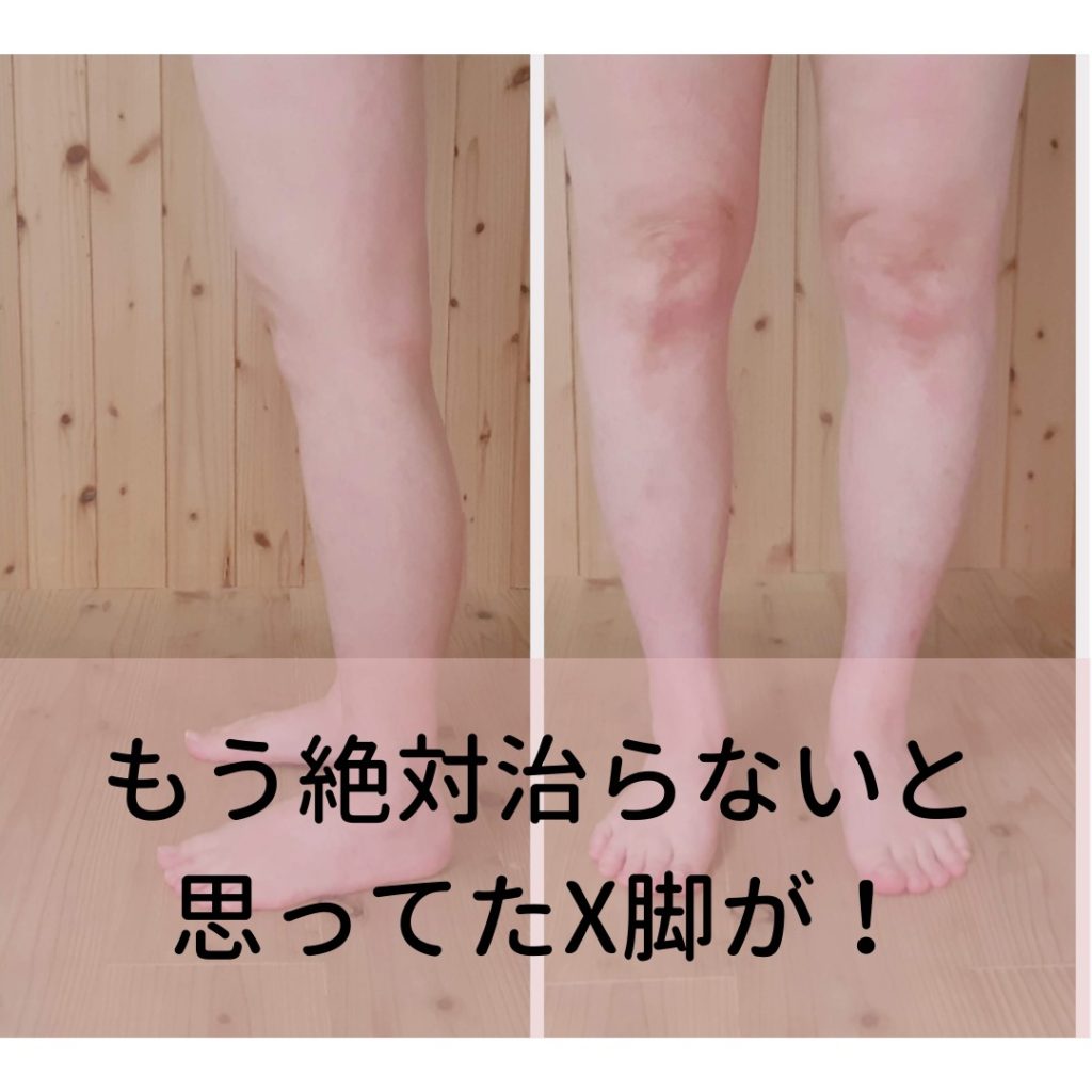 X脚,肩こり,腰痛,ぎっくり腰,解消,原因,肩こり解消,改善,頭痛,首こり,腰痛原因,ヨガ,ストレッチ,体操,整体, 骨盤の歪み